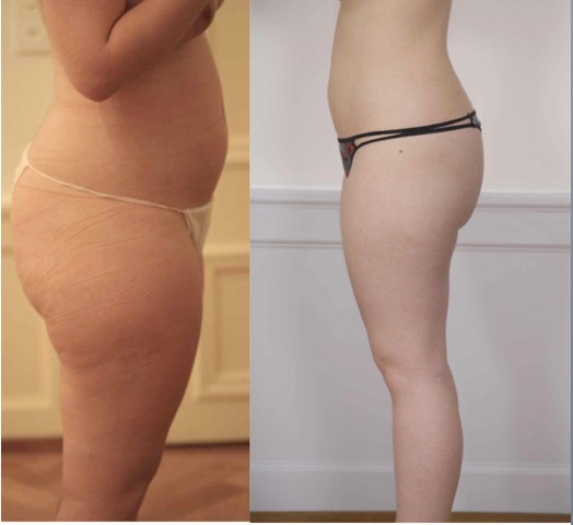 Foto Body (12 kg Gewichtsabnahme nach 13 Behandlungen)