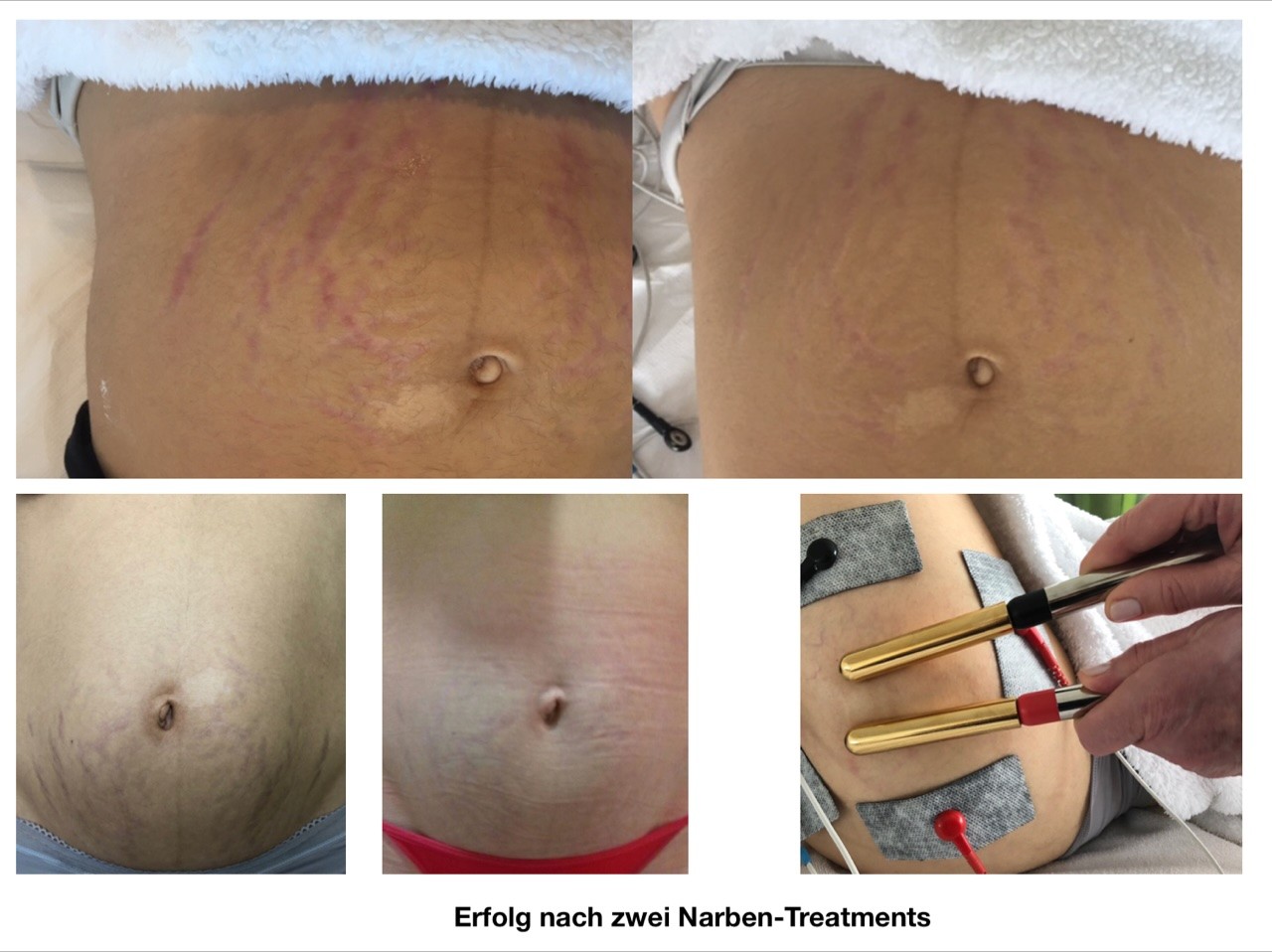 narbenbehandlung